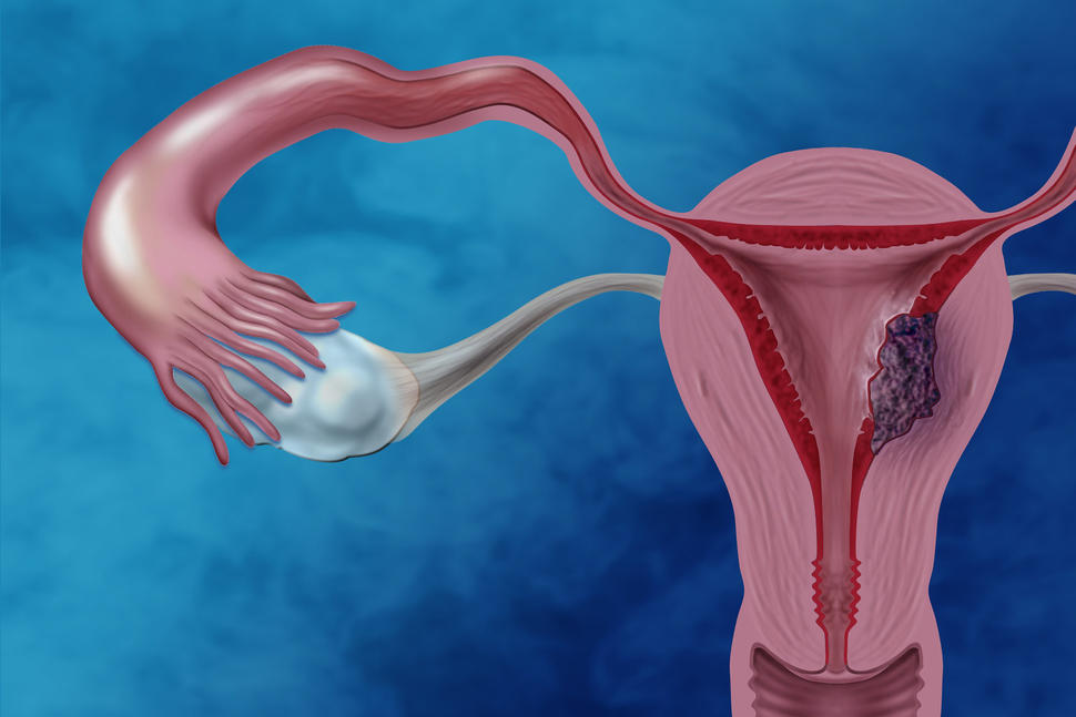 Illustration of the female reproductive system showing cancer cells in the endometrium.