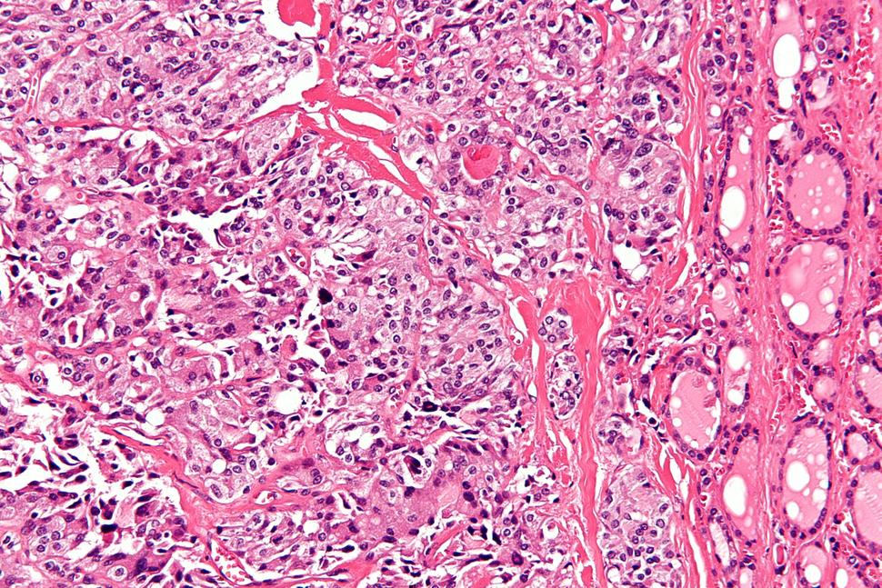 Photo taken through a microscope to show medullary thyroid carcinoma.