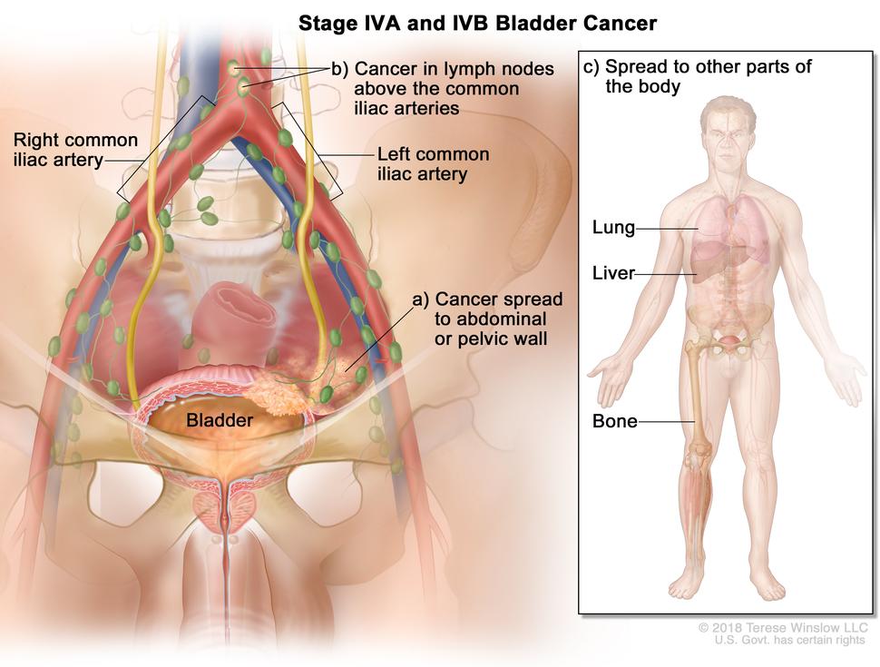 An illustration of blood cancer that has spread to other parts of the body.