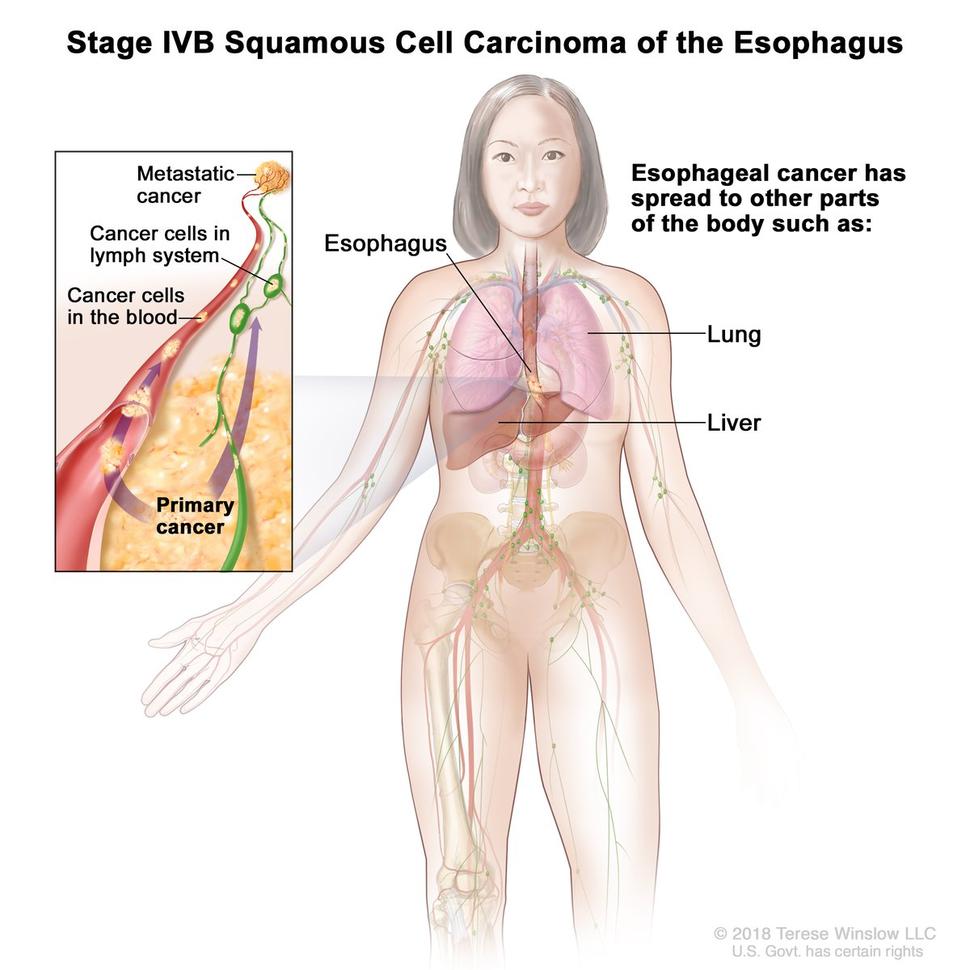 An anatomic illustration of stage IVB esophageal cancer.