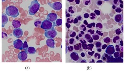 Pathology slides from a patient with acute myeloid leukemia that has relapsed (left) and after remission (right).