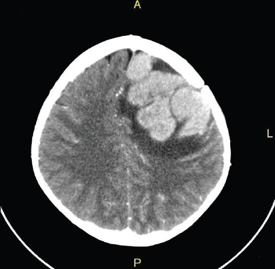 Exploración con tomografía computarizada (TC) de una recidiva tumoral en el cerebro de un niño con LLA.