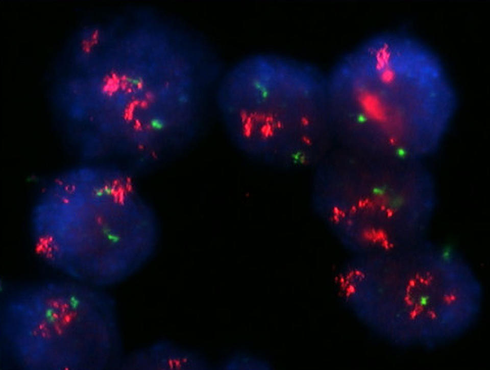 Una imagen de células de cáncer de seno con amplificación intensa de HER2.