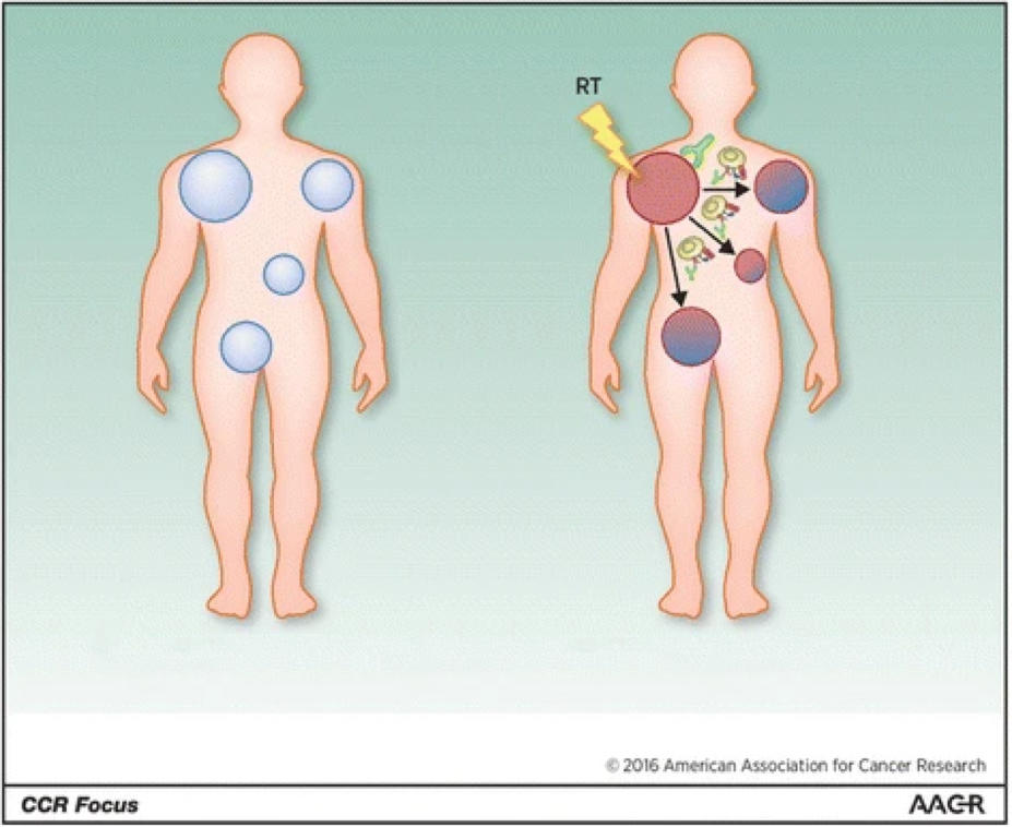 Una ilustración del efecto abscopal, que ocurre cuando la radiación, u otro tipo de terapia localizada, achica el tumor tratado, pero también achica los tumores en el cuerpo que no se trataron.