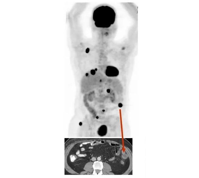 PET/CT scan of a patient with metastatic melanoma.