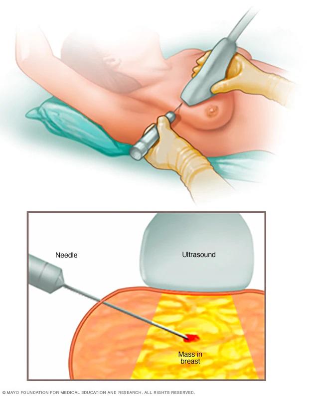 Illustration of a core needle biopsy of the breast.