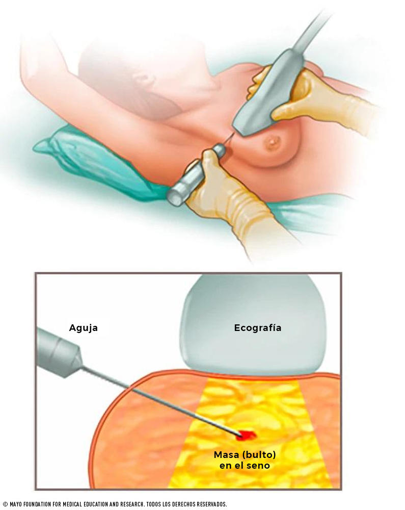 Ilustración de una biopsia con aguja gruesa.