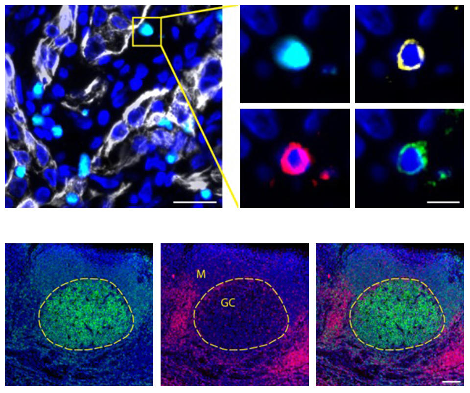 Images of different fluorescing cells around tumors.