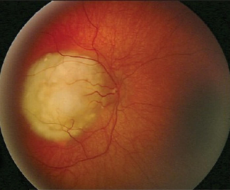 Retinoblastoma of the eye