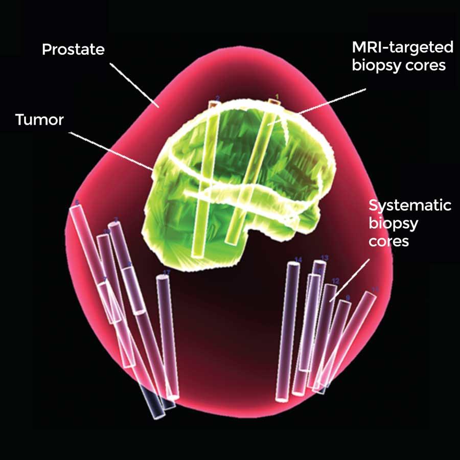 prostate cancer national cancer institute)