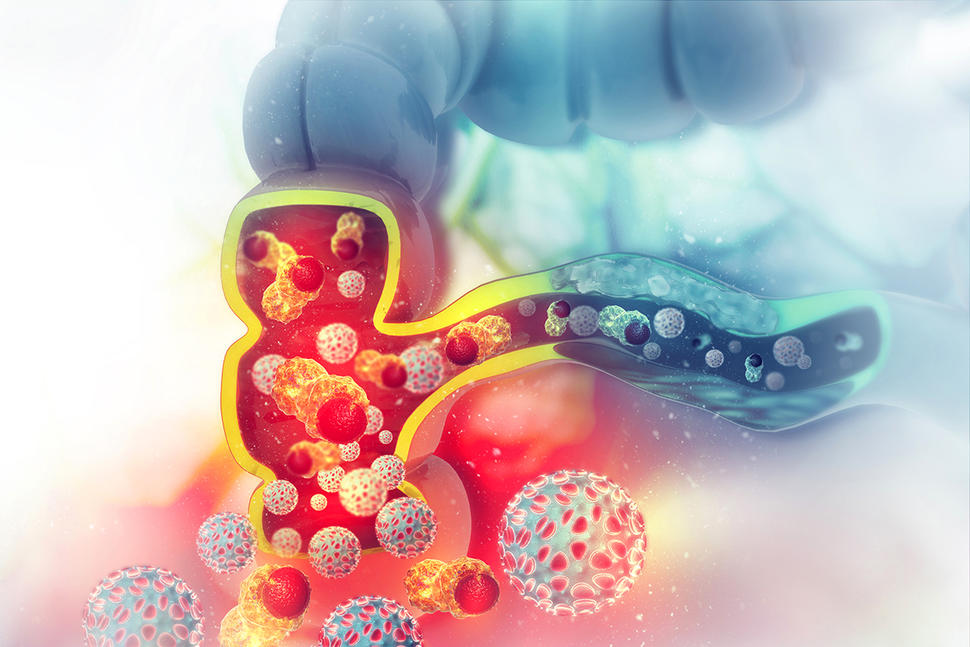 Colon Cancer Attacking Cell