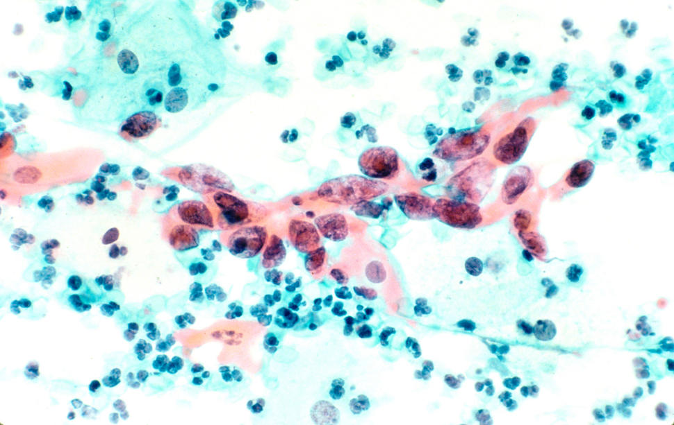 Cytological Specimen Showing Cervical Cancer