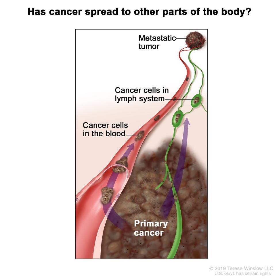 Aggressive cancer lymph nodes