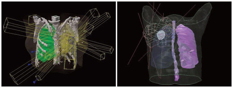 A case of stereotactic body radiation therapy (SBRT) for early stage lung cancer (T1N0M0)