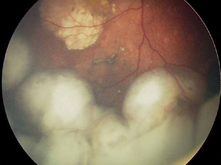 Fundoscopic exam revealing an intraocular retinoblastoma before treatment with intra-arterial chemotherapy