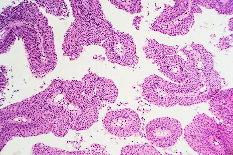 Microscopic section of a papillary urothelial (transitional cell) carcinoma, showing characteristic papillary structures with fibrovascular cores.