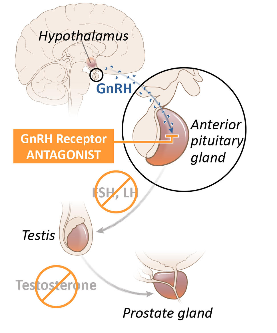 Image of Relugolix effects for advanced prostate cancer