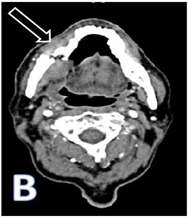 CT scan showing osteonecrosis of the lower jaw with an arrow pointing to a fracture.