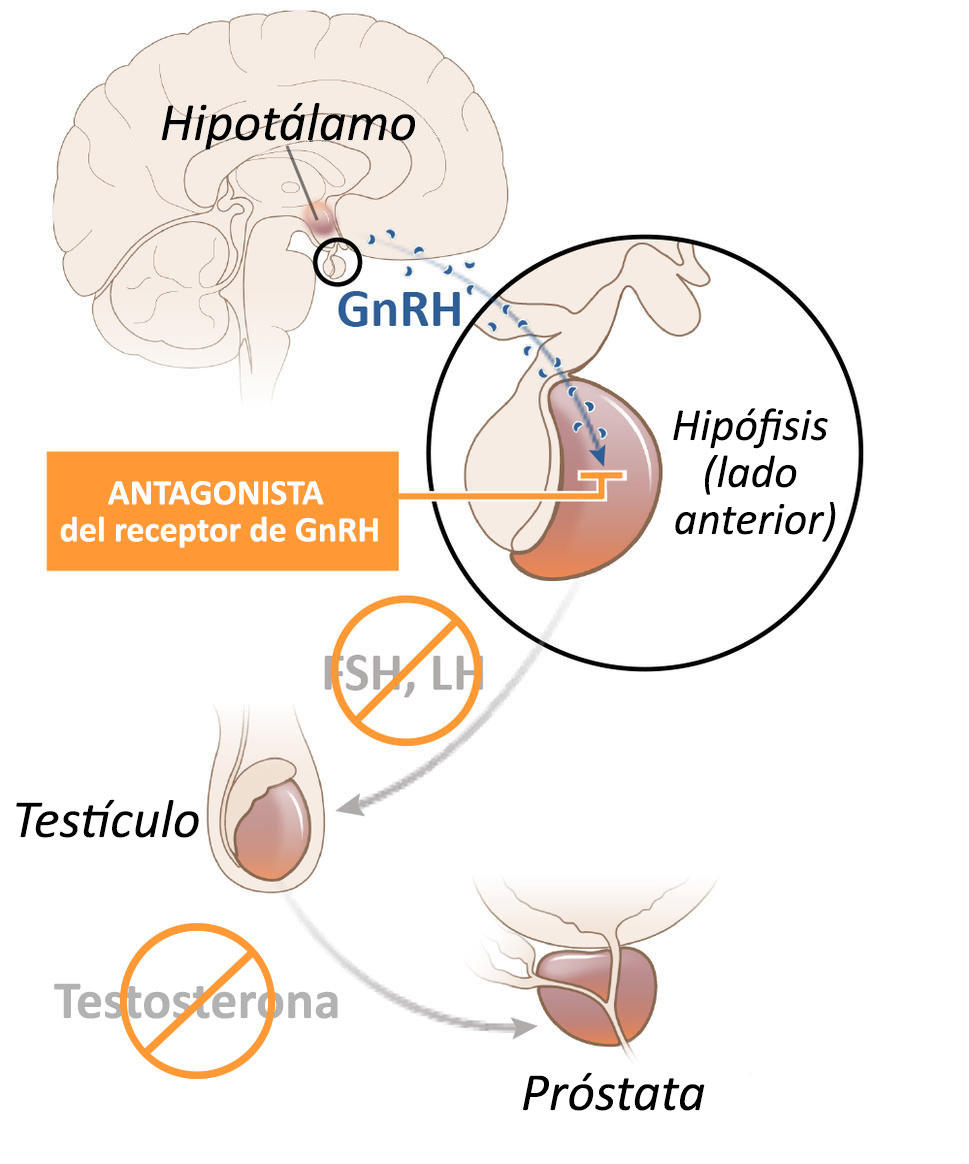 Cancer de la prostata tratamiento, Ingrijiri paliative in cancer - infrmatii utile | Cancer