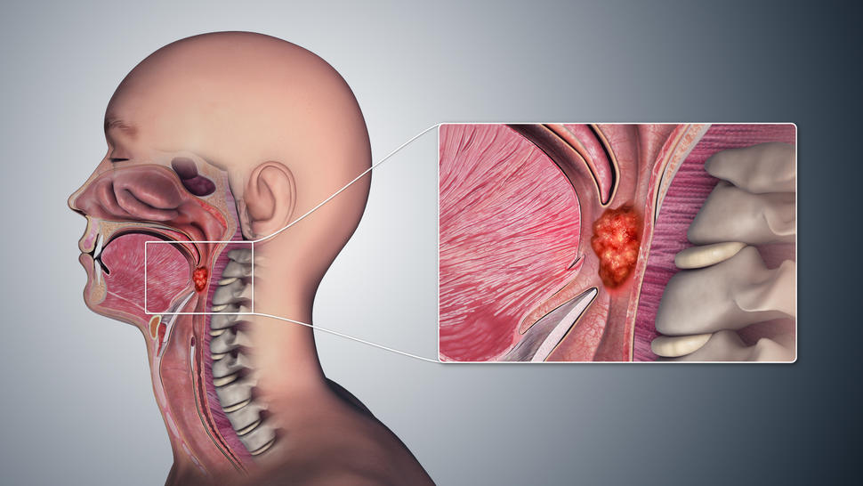 where does hpv throat cancer spread
