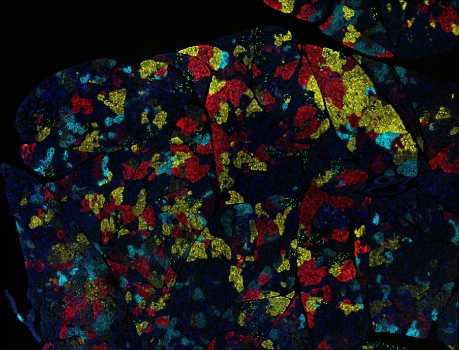 Image of a mouse model of pancreatic cancer shows multi-color lineage tracing.