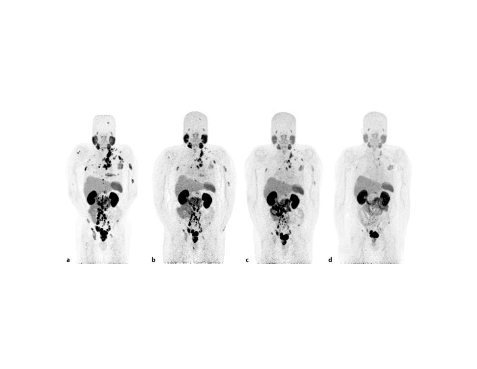 Serie de tomografía por emisión de positrones que muestran menos tumores después del tratamiento con Lu177-PSMA-617