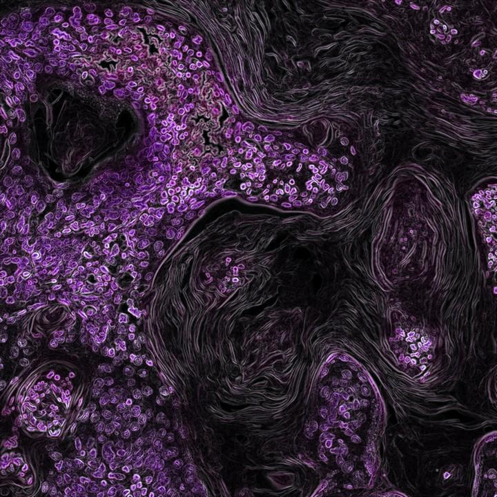Una muestra de células de cáncer de pulmón (moradas) con mutaciones oncoiniciadoras en KRAS, en un modelo de cáncer de pulmón en ratones