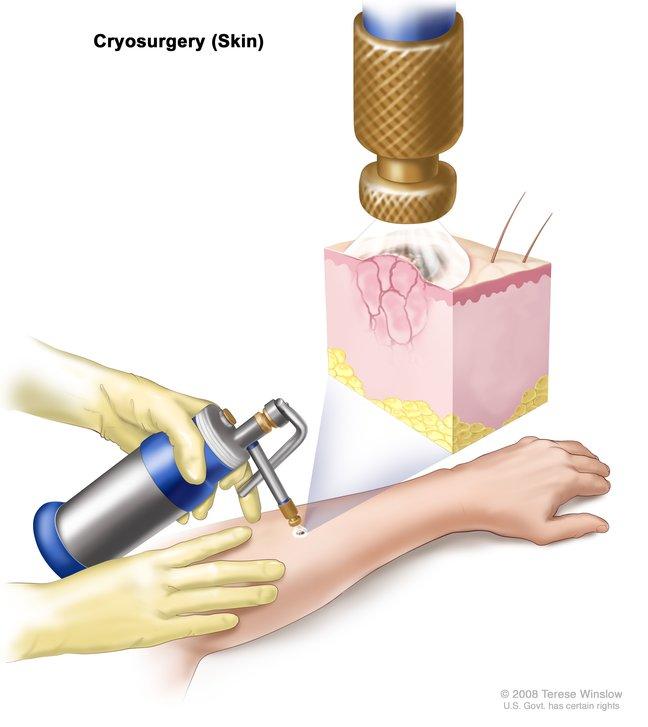apparatus that delivers cryosurgery, which is a metal canister with a nozzle, pointed at the skin 