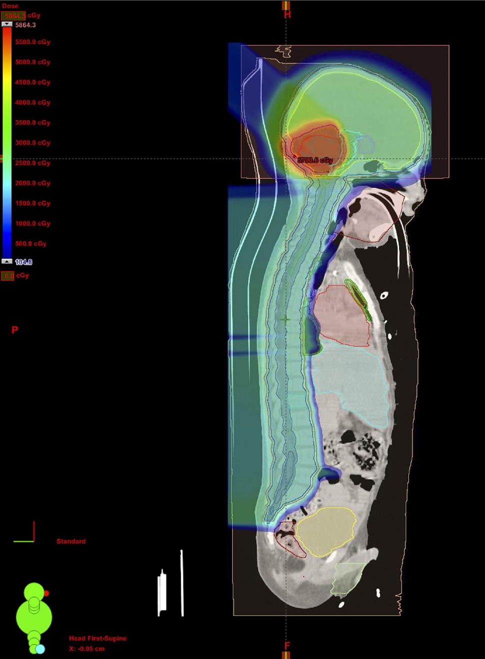 CT image of radiation plan for child with medulloblastoma