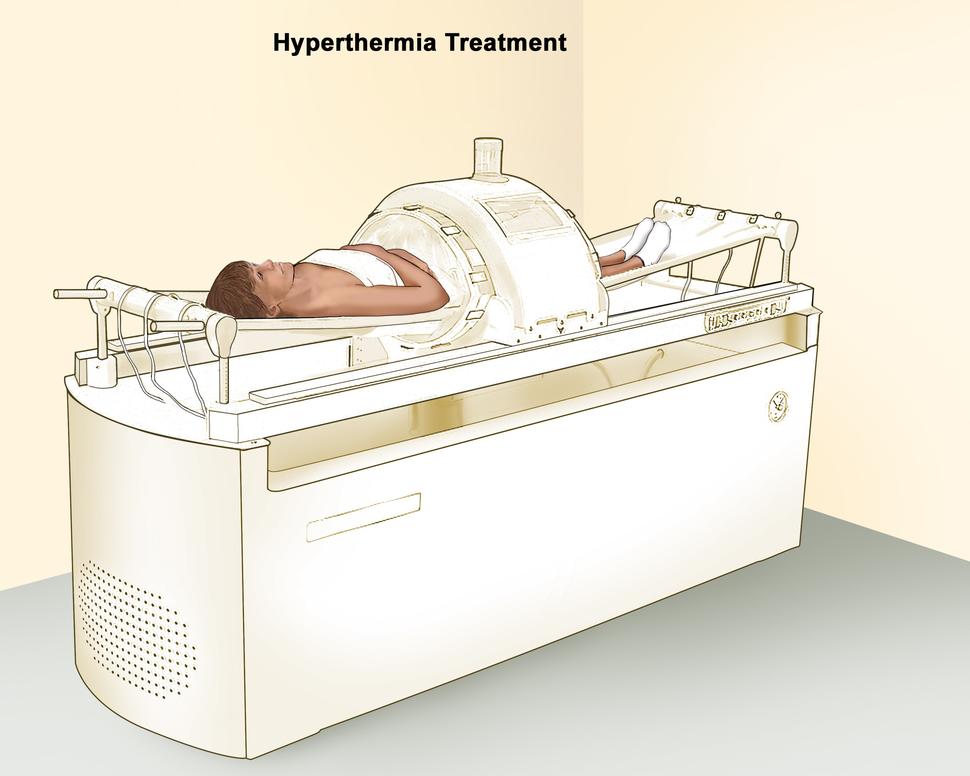 Hyperthermia treatment; drawing shows a woman lying on a table with a dome-shaped machine around the middle part of the body. The machine delivers heat directly to the treatment area.