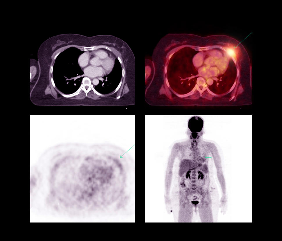 Imagines de tomografía por emisión de positrones con tomografía computarizada (TEP-TC) de un tumor que volvió en una persona con cáncer de pulmón.