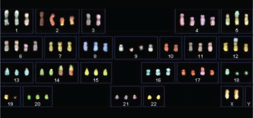 A process called spectral karyotyping shows widespread aneuploidy in a cell line of lung cancer.