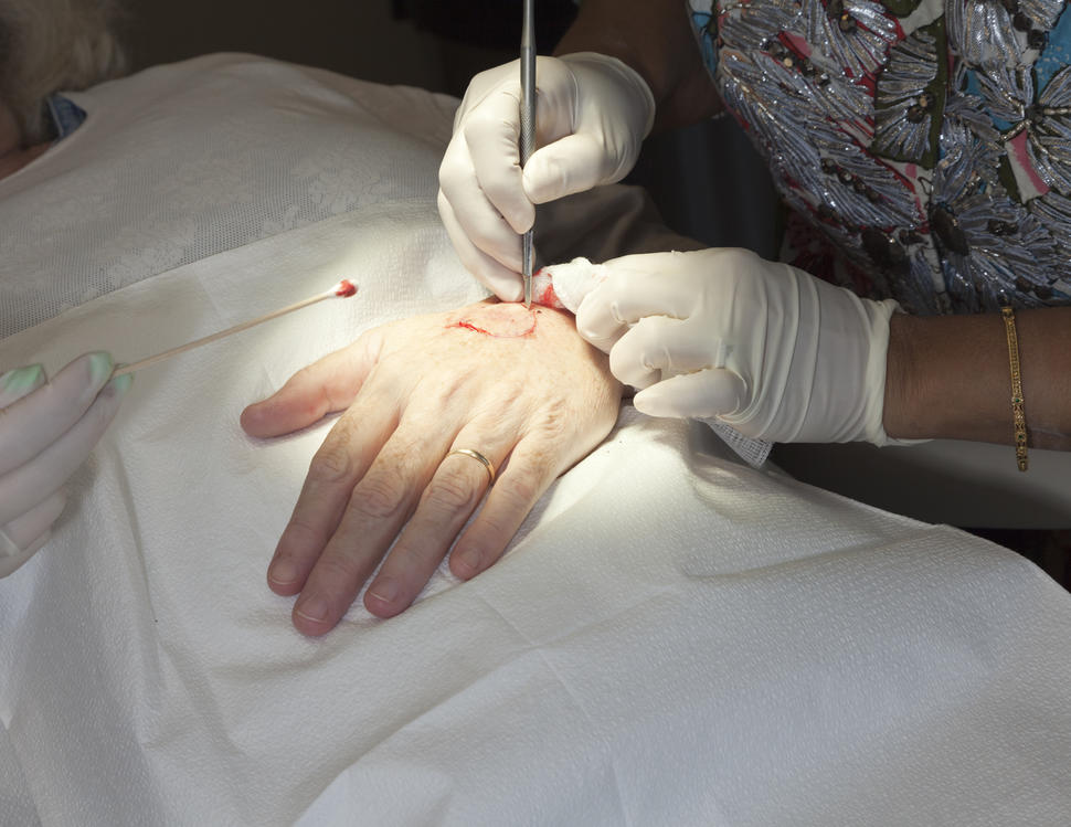 Un médico usa un bisturí y hace un corte alrededor de un melanoma en el dorso de la mano.