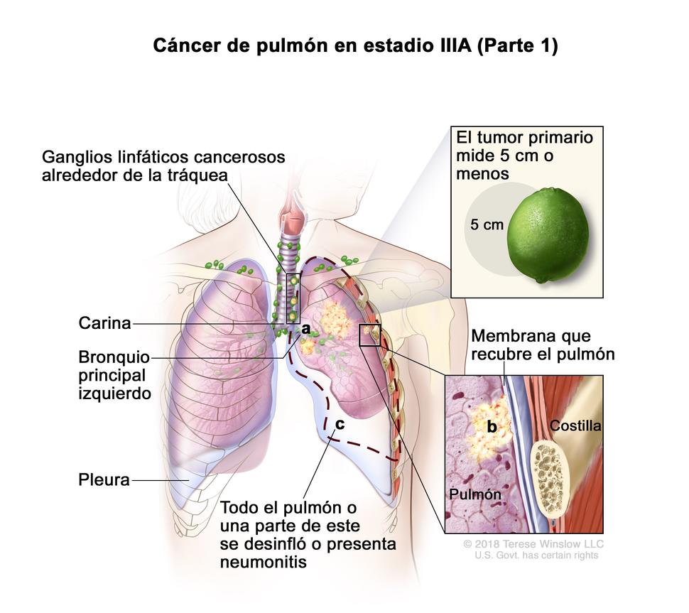 En la imagen se observan un tumor primario que mide 5 cm o menos en el pulmón izquierdo y ganglios linfáticos cancerosos alrededor de la tráquea. También se observa que el cáncer se diseminó al bronquio principal izquierdo y a la membrana que recubre el pulmón.