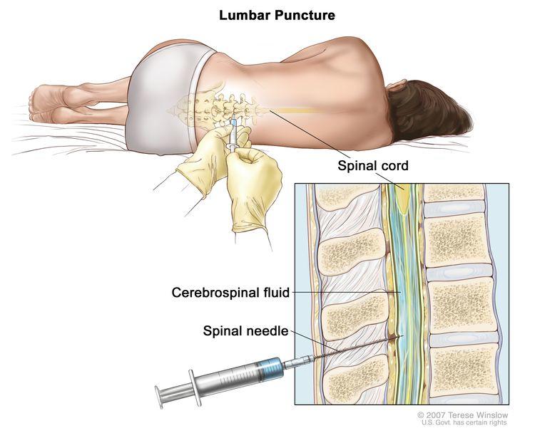 Low-coverage whole-genome sequencing of cerebrospinal-fluid