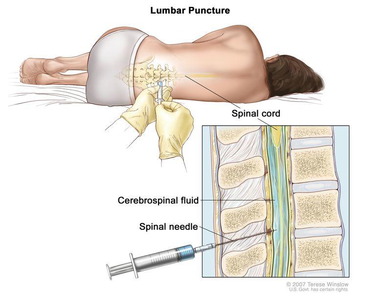 Illustration of a patient undergoing a lumbar puncture, with an inset showing the needle inserted into the lower part of the spinal column.