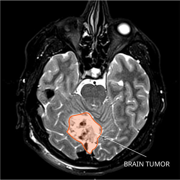 MRI of a medulloblastoma in the brain.