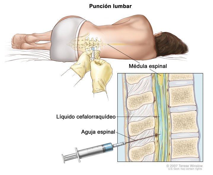 Punción lumbar