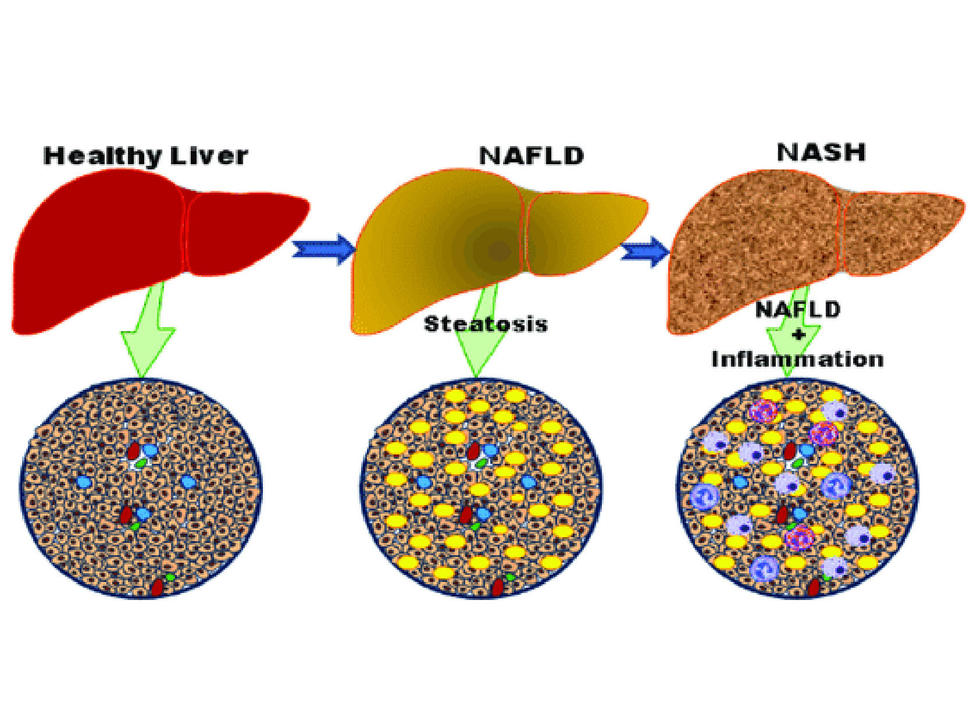Illustration showing progression from normal liver to nonalcoholic steatohepatitis.