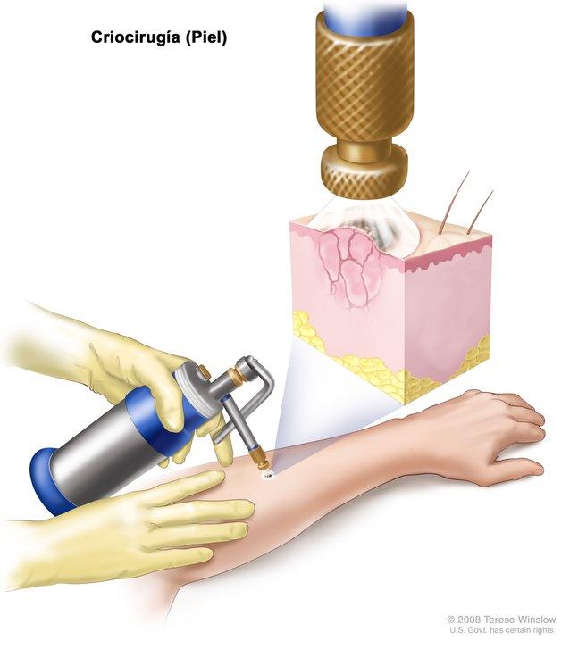 El dibujo muestra un cilindro de metal pequeño con una boquilla, el instrumento que se usa para aplicar la crioterapia, apuntando a un área anormal en la parte inferior del brazo de un paciente. 