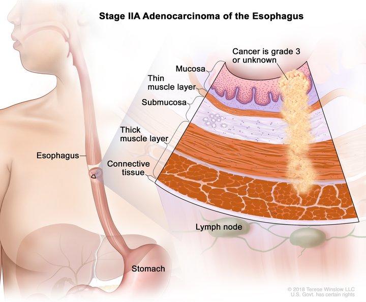 Esophageal Adenocarcinoma Stage IIA