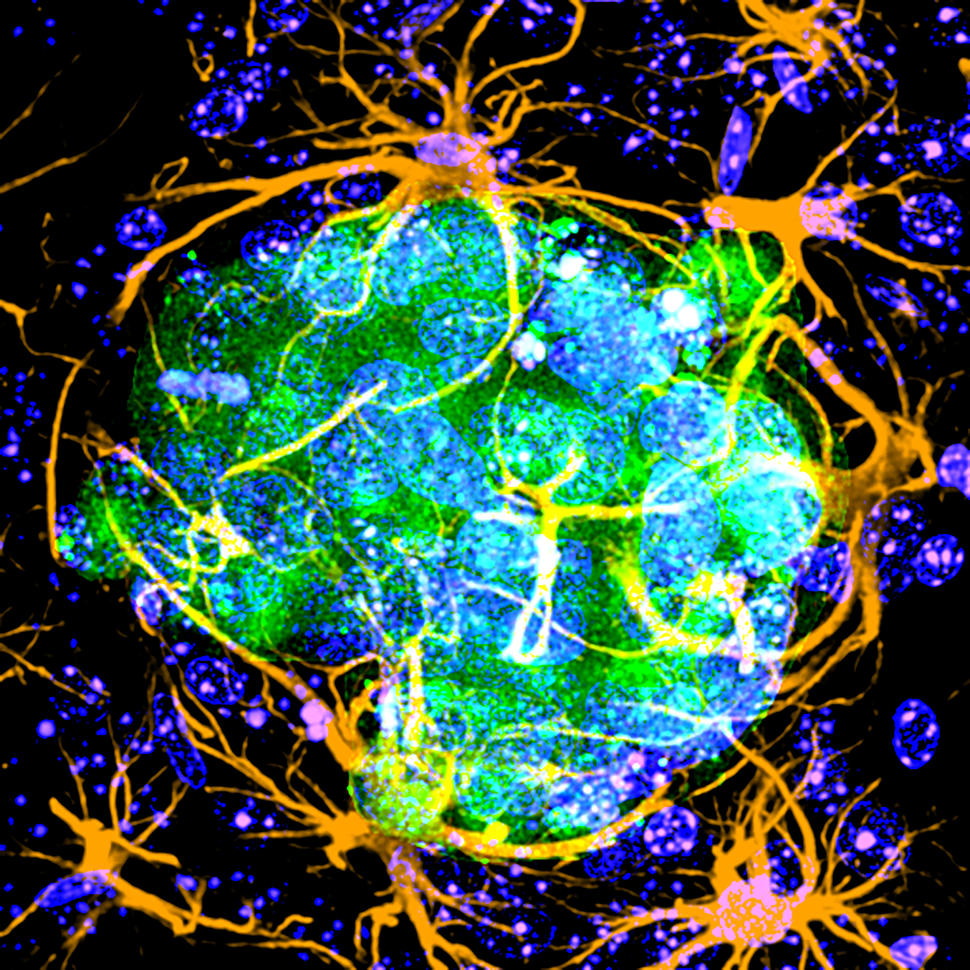 Melanoma cells in brain surrounded by astrocytes