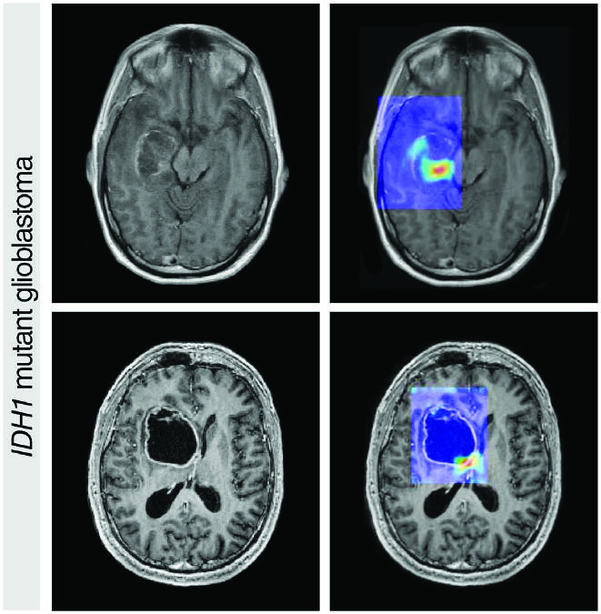 Image of cranial scan showing IDH1 mutant glioblastoma