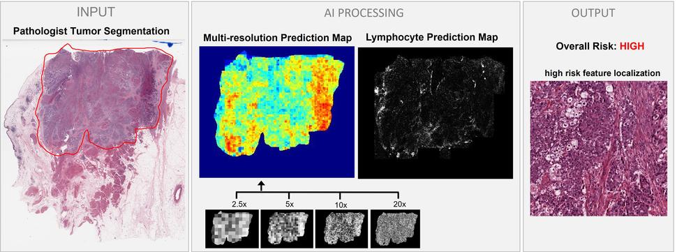 A series of images explaining how an AI model uses images of tumor tissue to predict whether the cancer has spread to the lymph nodes.