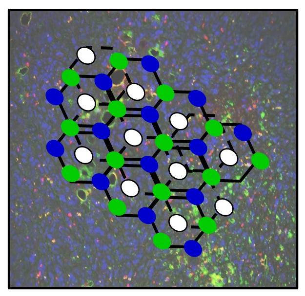 Image of a tumor overlayed with a representative illustration of a graphene material