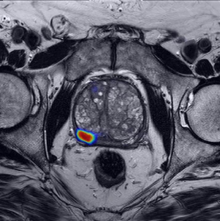 A black and white MRI image of the prostate gland with a small area of the prostate highlighted in multiple colors by an AI tool.