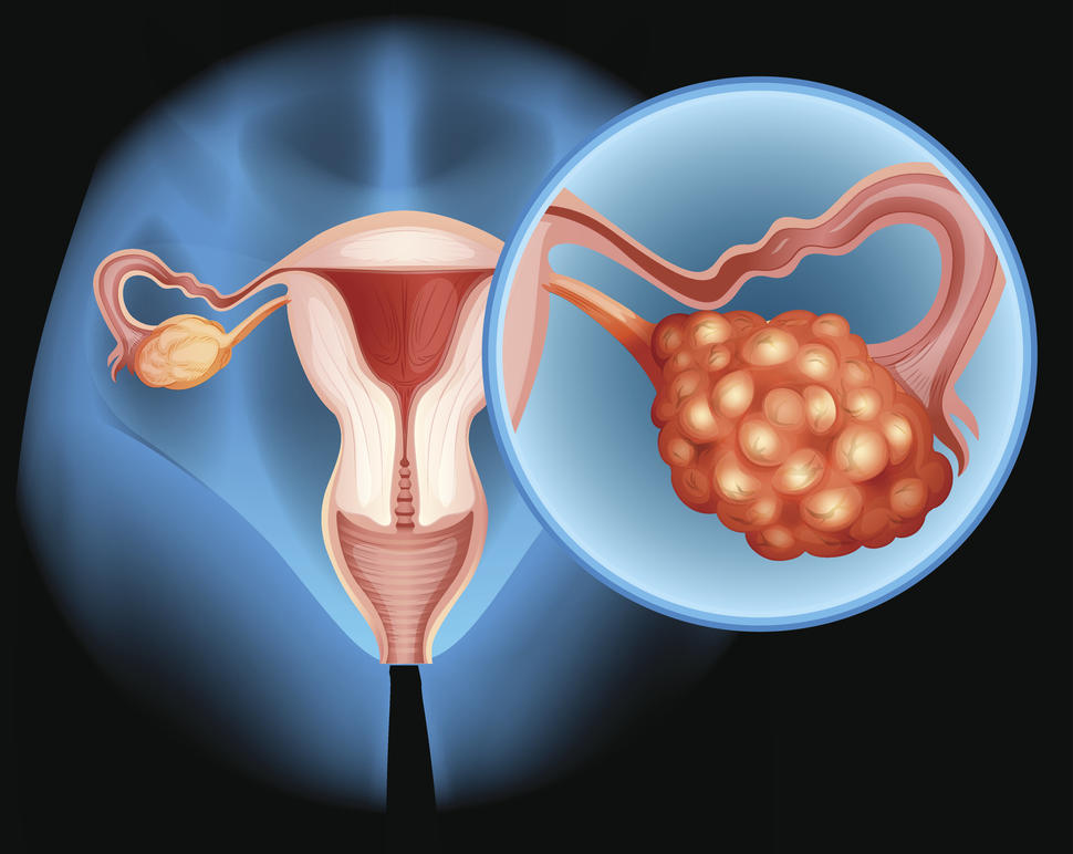 An illustration showing a tumor in an ovary.