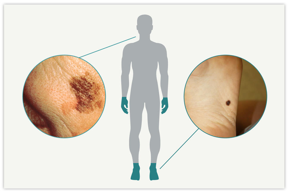 Silhouette of body with hands and feet highlighted; photo inset of melanoma on the face, the other photo inset pointing at melanoma on the sole of a foot