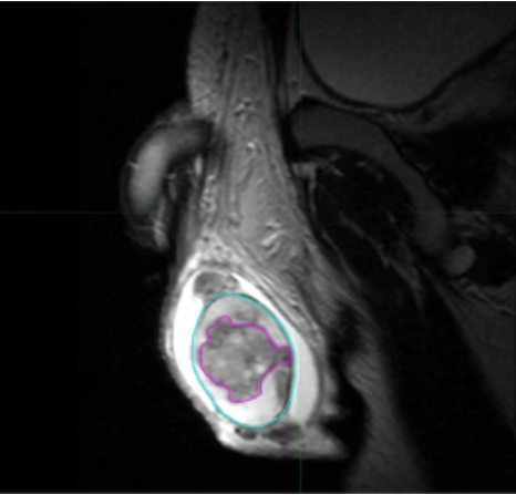 Una imagen de resonancia magnética en blanco y negro que muestra un umor de testículo, resaltado en rosa.