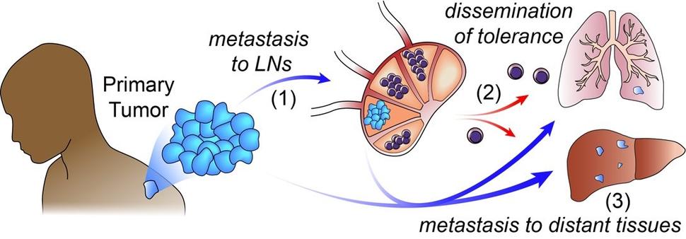 Graphic depicting tumor cells leaving the primary tumor and entering a lymph node. Immune cells leave the lymph node and enter the lungs and liver.